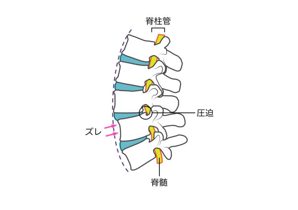 腰部脊柱管狭窄症画像