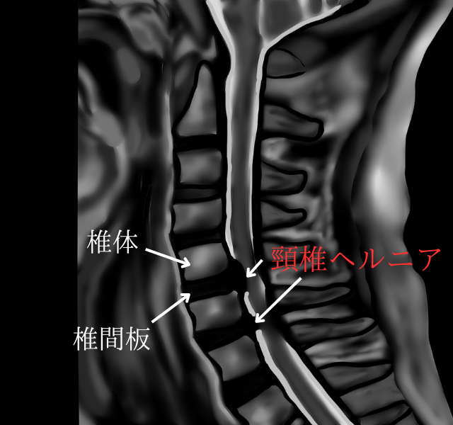 頸椎ヘルニア画像