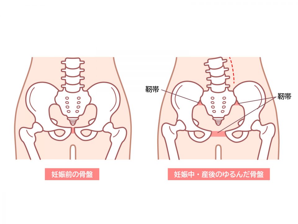 産後緩んだ骨盤画像